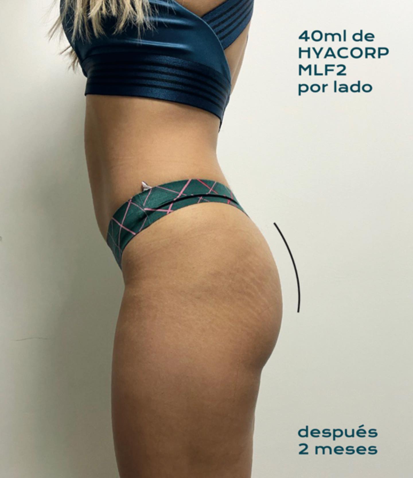 Antes y después · comparativo — después