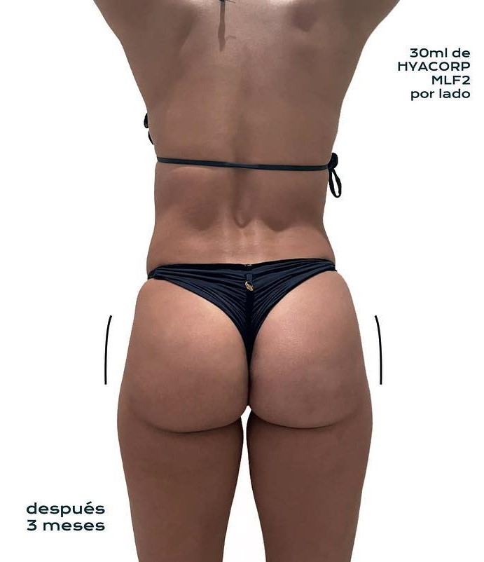 Antes y después · comparativo — después
