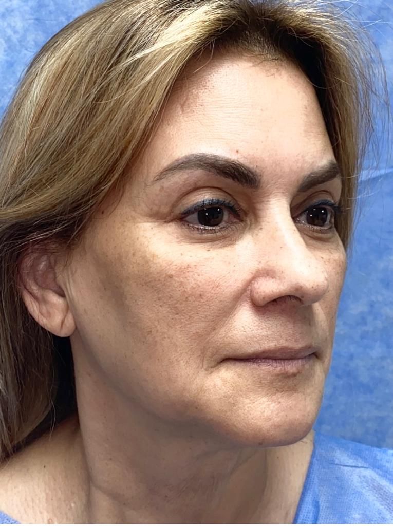Antes y después · comparativo — antes