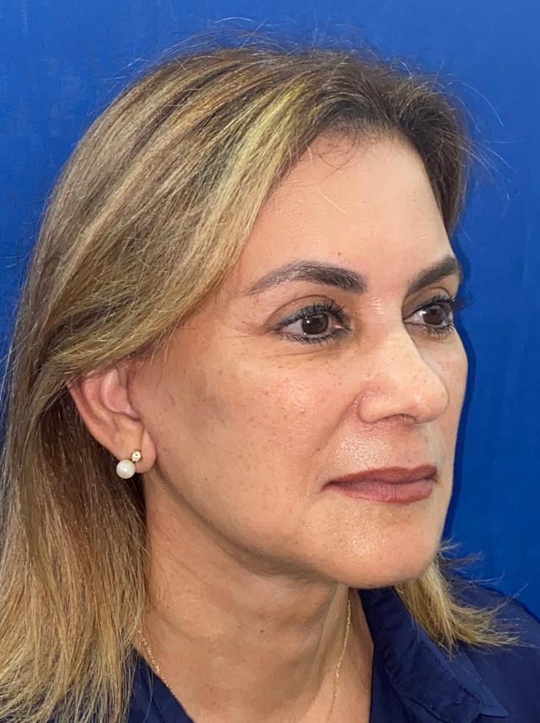 Antes y después · comparativo — después
