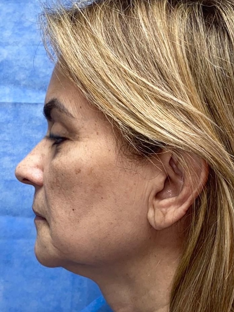 Antes y después · comparativo — antes