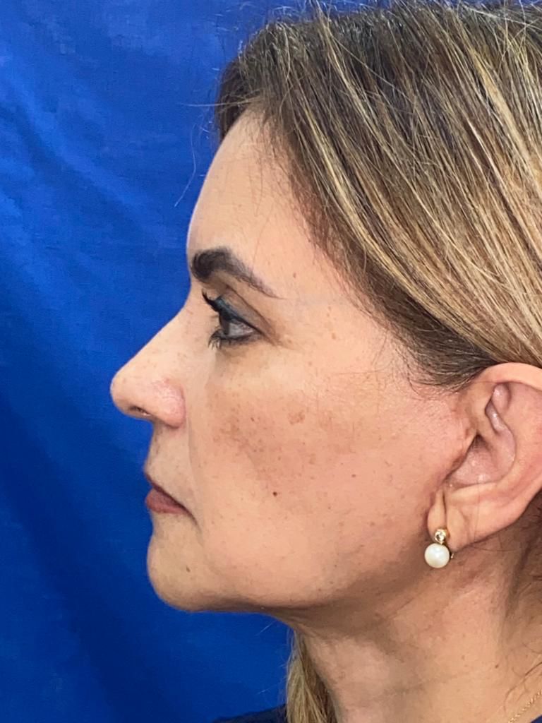 Antes y después · comparativo — después