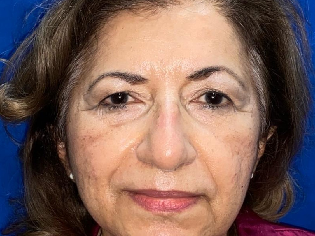Antes y después · comparativo — antes