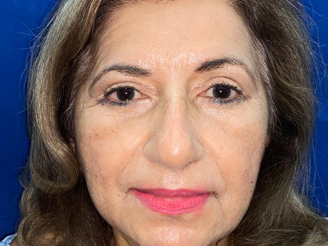Antes y después · comparativo — después