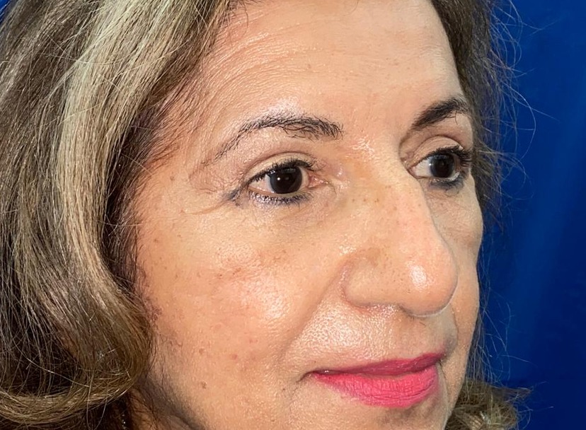 Antes y después · comparativo — después