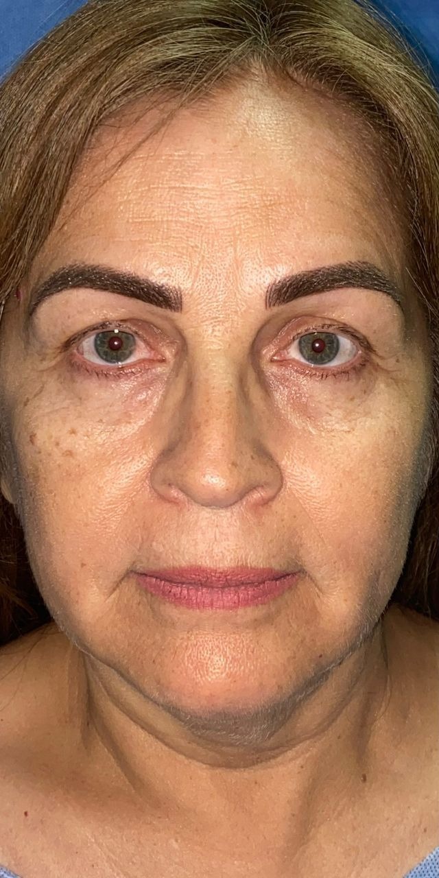 Antes y después · comparativo — antes