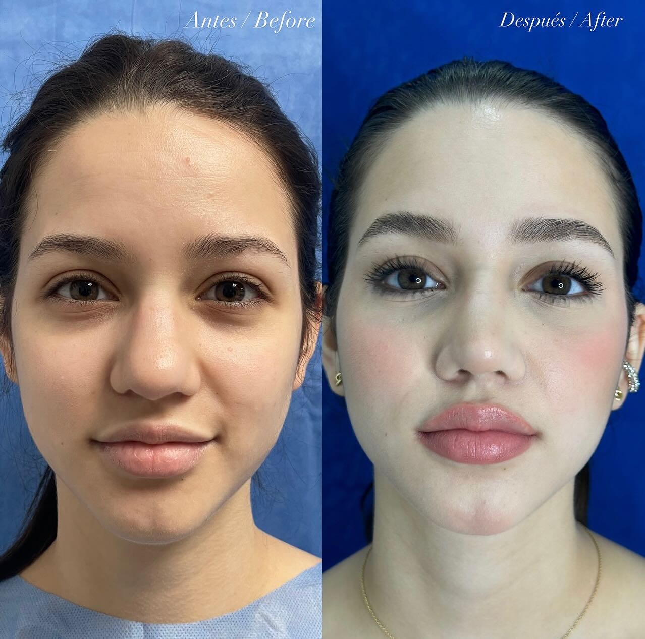 Antes y después · comparativo