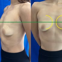 Antes y después · comparativo